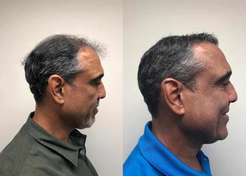 Patient p388 hair transplant before and after right view