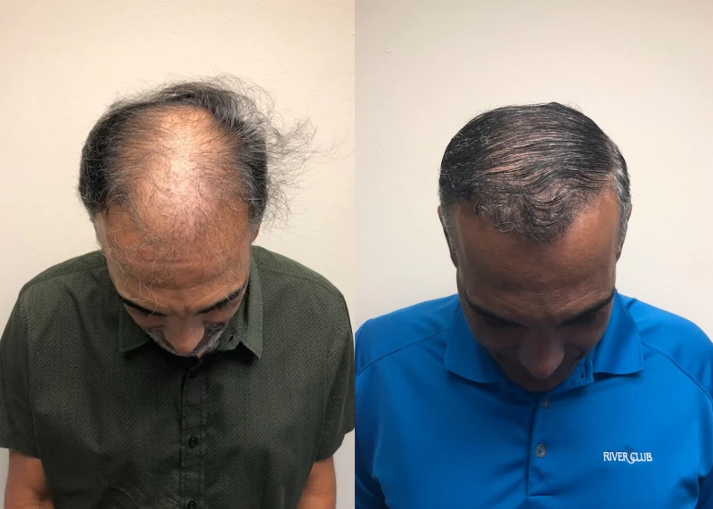 Patient p388 hair transplant before and after tilt view