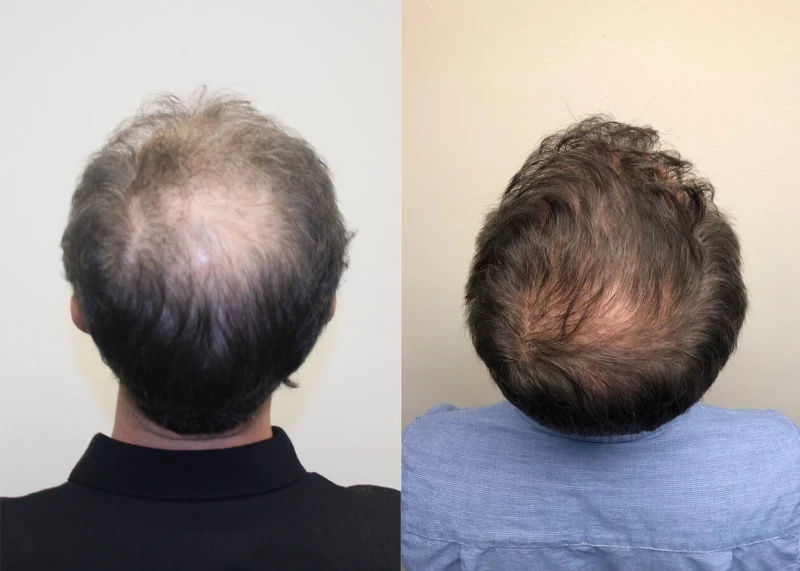 Patient p389 hair transplant before and after crown view