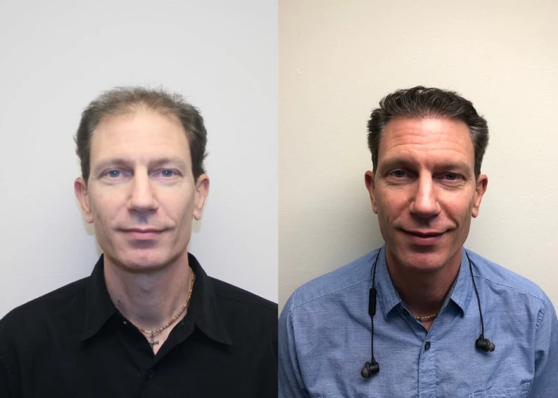 AI Hair Transplant Before and After