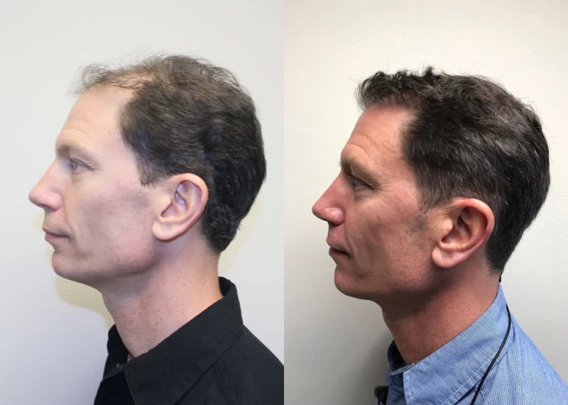 Patient p389 hair transplant before and after left view