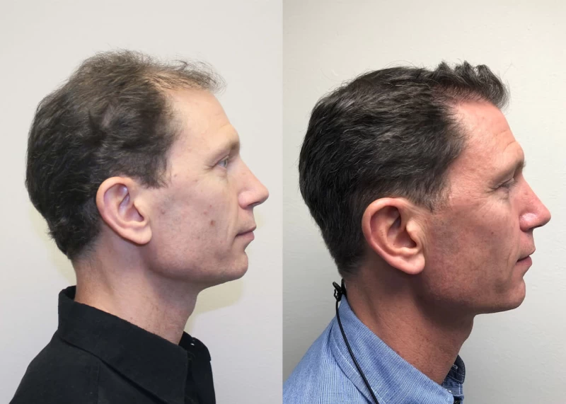Patient p389 hair transplant before and after right view
