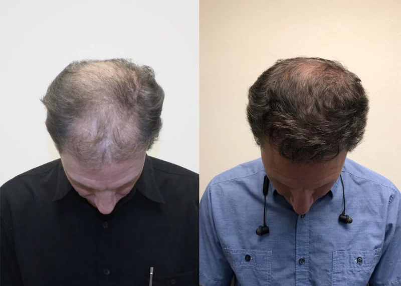 Patient p389 hair transplant before and after tilt view