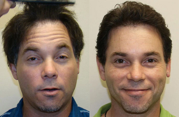 Todd Hair Transplant Before and After
