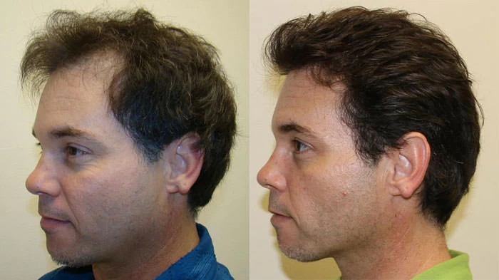 Patient p38 hair transplant before and after left view