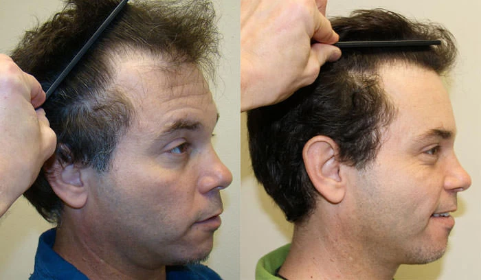 Patient p38 hair transplant before and after right view