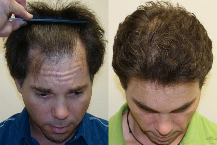 Patient p38 hair transplant before and after tilt view