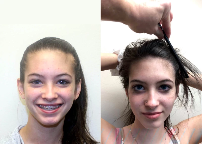 Hannah corrective hair surgery burn patient before and after front view