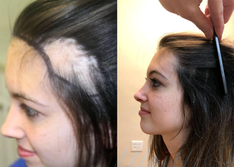 Hannah corrective hair surgery burn patient before and after left view