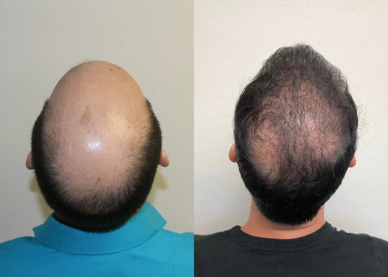 Patient p391 hair transplant before and after crown view