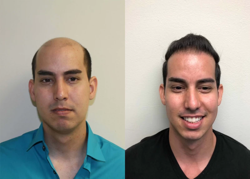 Aly Hair Transplant Before and After