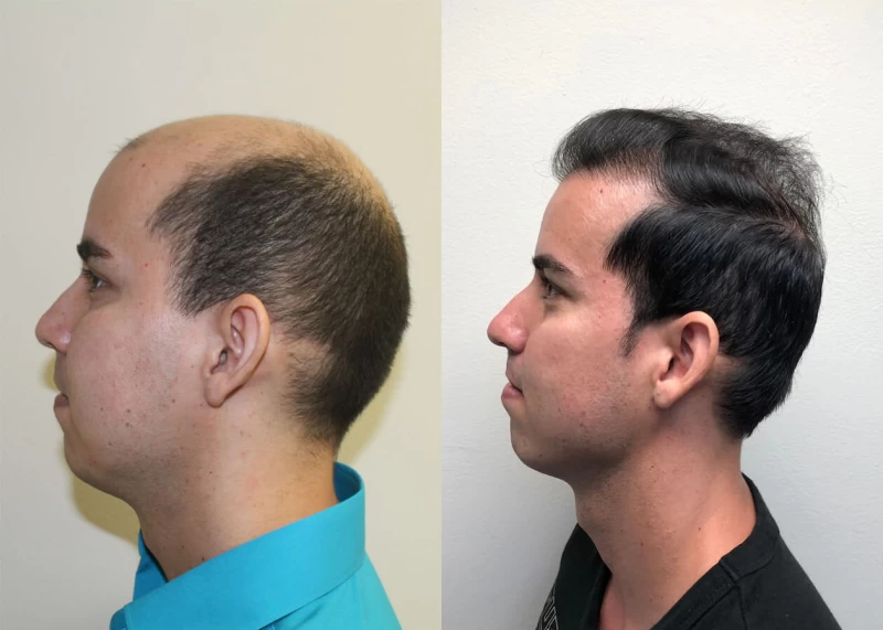Patient p391 hair transplant before and after left view