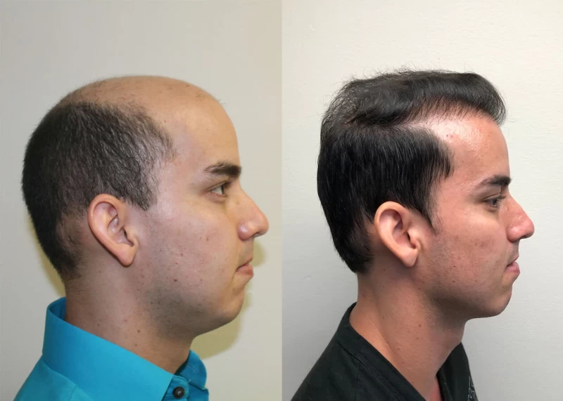 Patient p391 hair transplant before and after right view