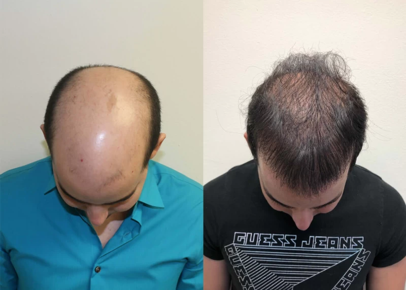 Patient p391 hair transplant before and after tilt view
