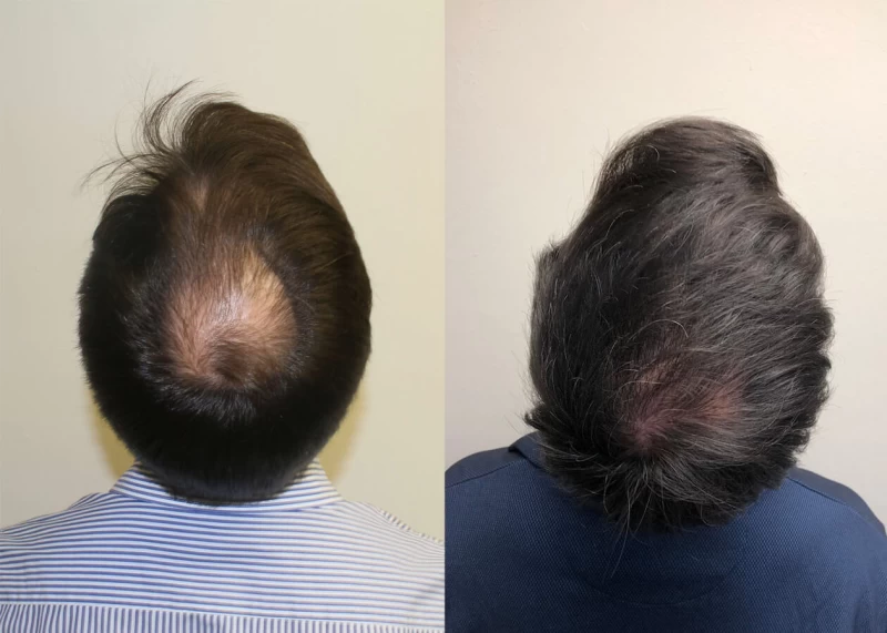 Patient p392 hair transplant before and after crown view