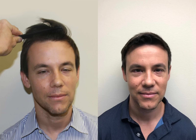 Eric Hair Transplant Before and After