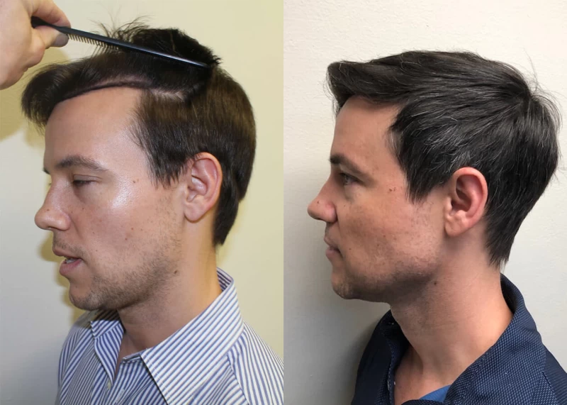 Patient p392 hair transplant before and after left view