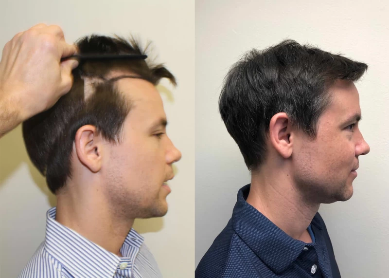 Patient p392 hair transplant before and after right view