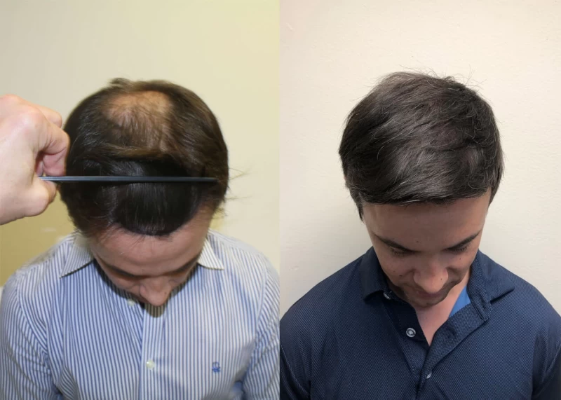 Patient p392 hair transplant before and after tilt view