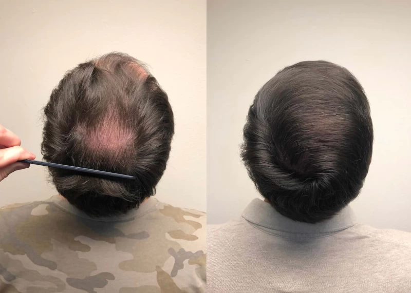 Patient p393 hair transplant before and after crown view