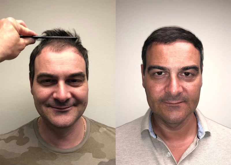 Dejan Hair Transplant Before and After