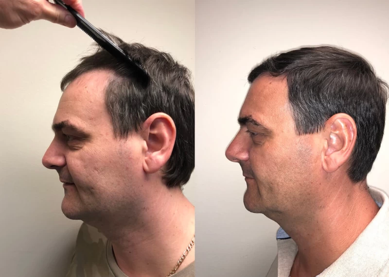 Patient p393 hair transplant before and after left view