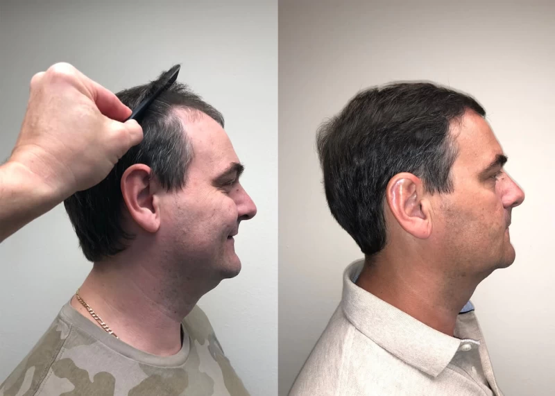 Patient p393 hair transplant before and after right view