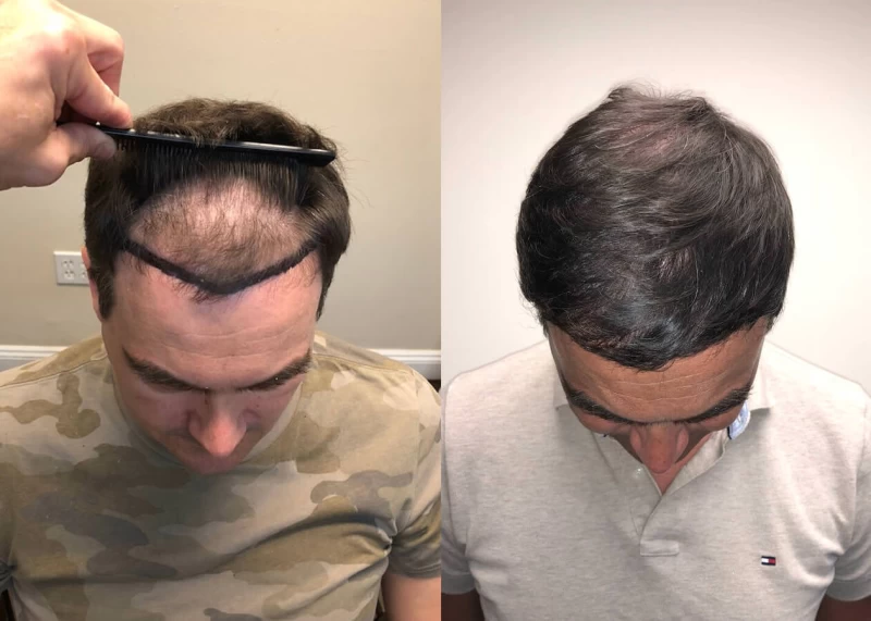 Patient p393 hair transplant before and after tilt view