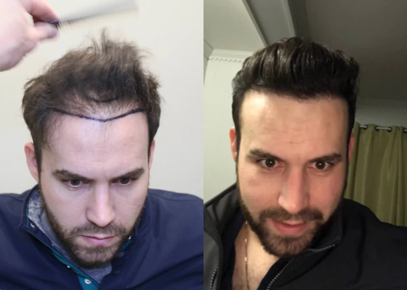Martins Hair Transplant Before and After