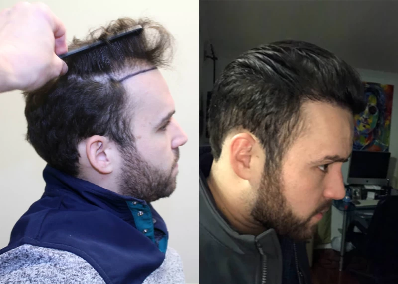 Patient p394 hair transplant before and after right view