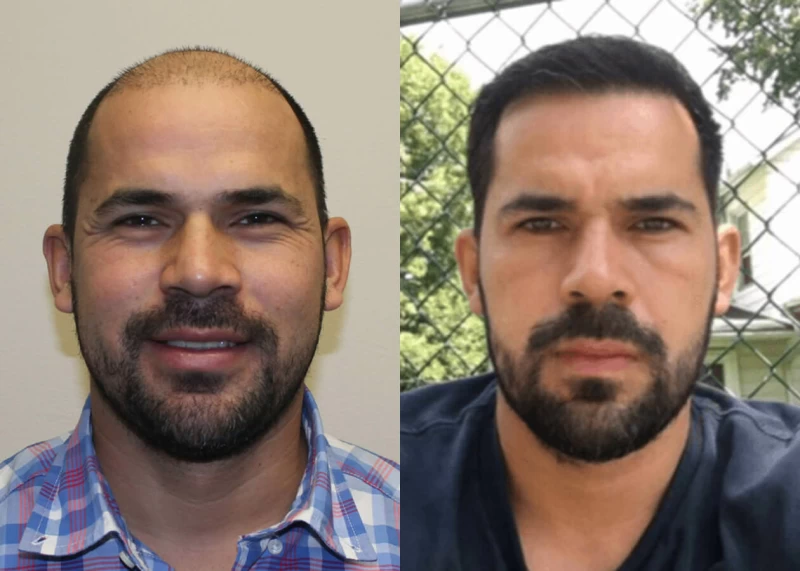 Zavala Hair Transplant Before and After