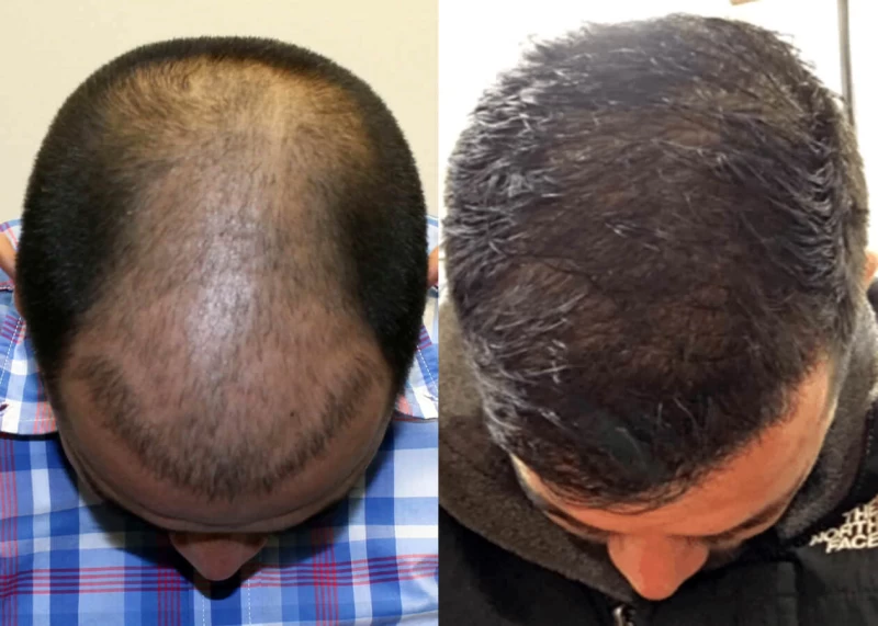 Patient p395 hair transplant before and after tilt view
