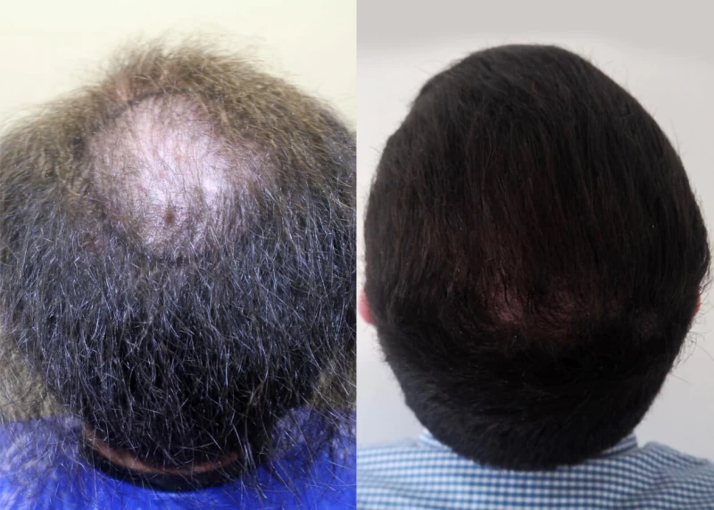 Patient p396 hair transplant before and after crown view