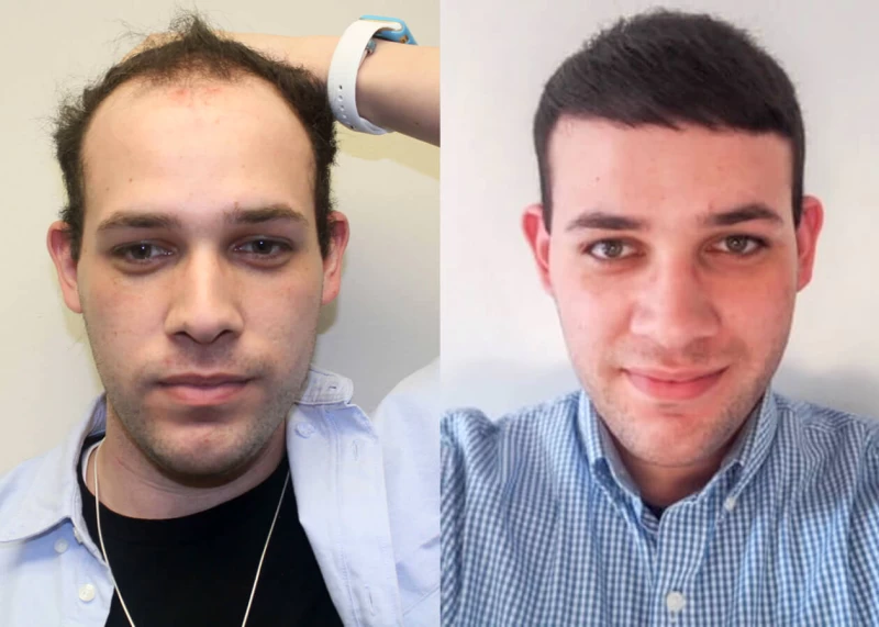 Otero Hair Transplant Before and After