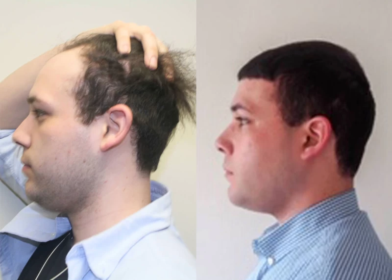 Patient p396 hair transplant before and after left view