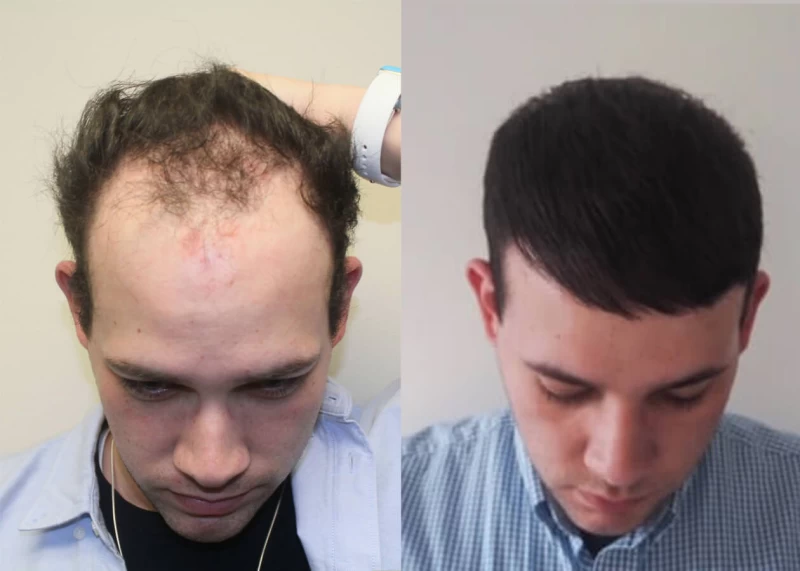Patient p396 hair transplant before and after tilt view