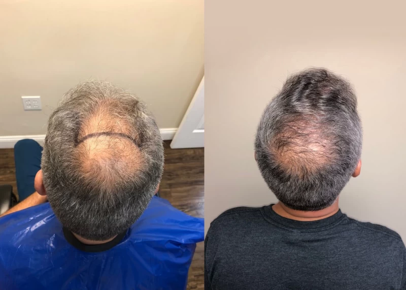 Patient p397 hair transplant before and after crown view
