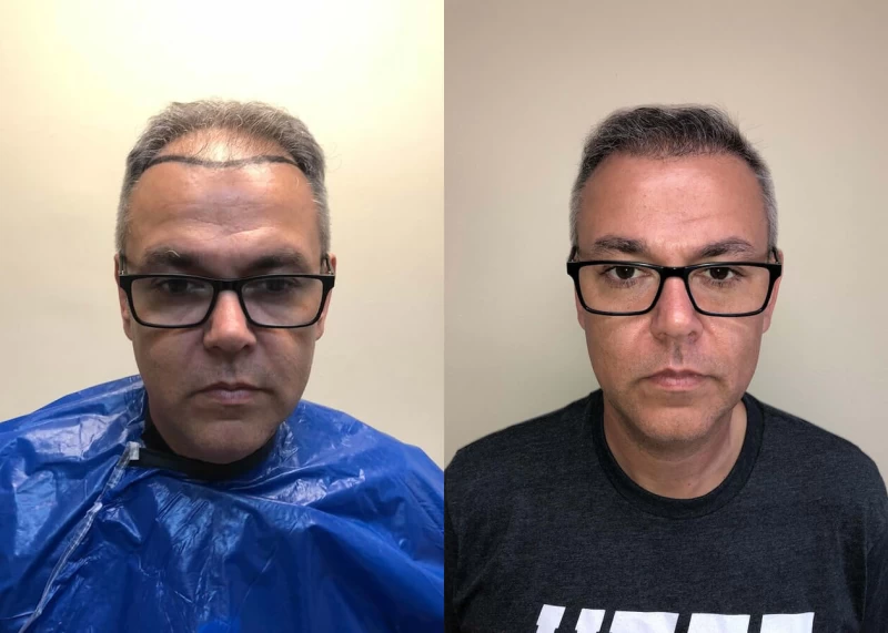 Eduardo Hair Transplant Before and After