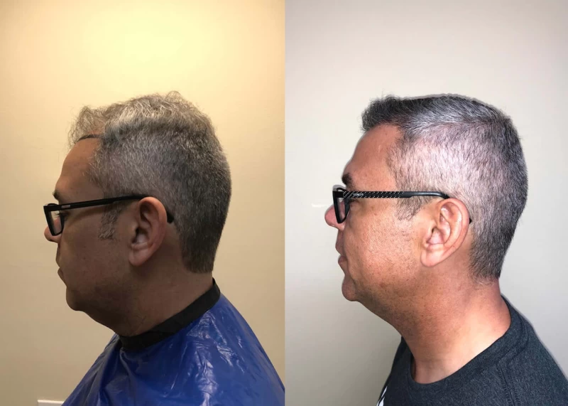 Patient p397 hair transplant before and after left view