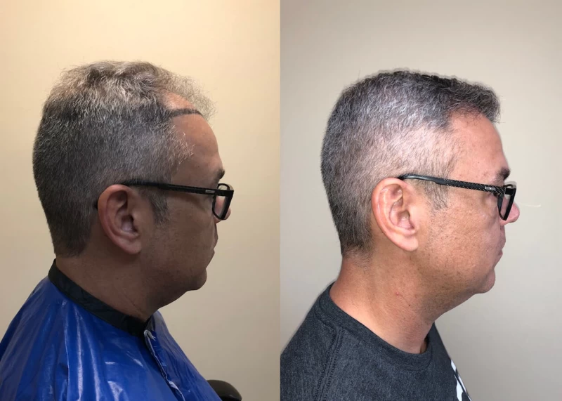 Patient p397 hair transplant before and after right view