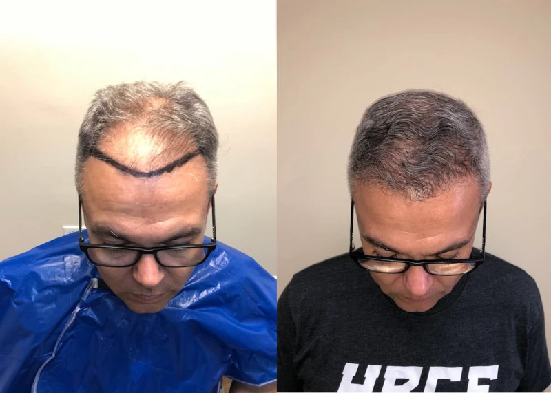 Patient p397 hair transplant before and after tilt view