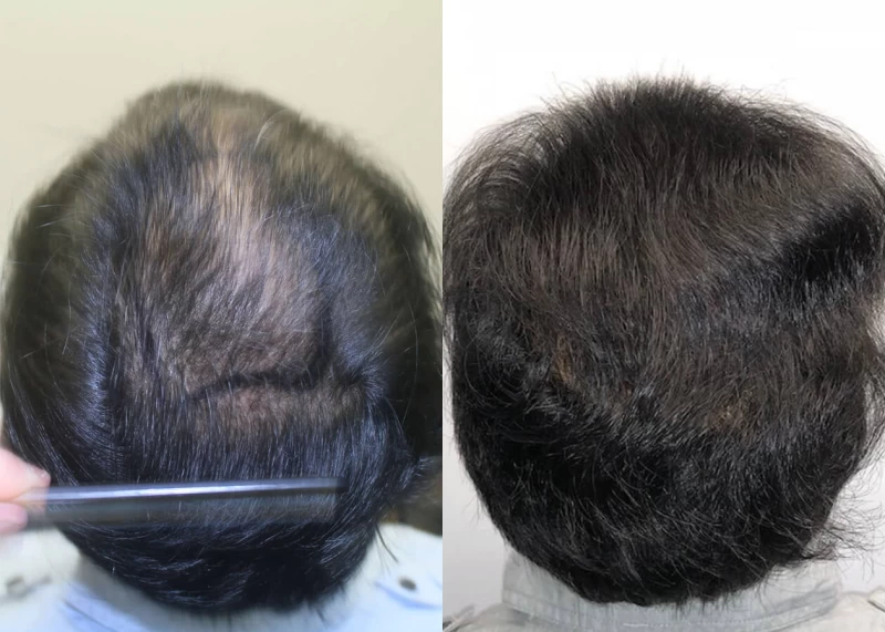Patient p398 hair transplant before and after crown view