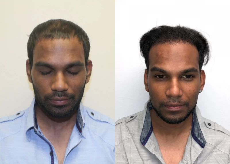 Davindra Hair Transplant Before and After