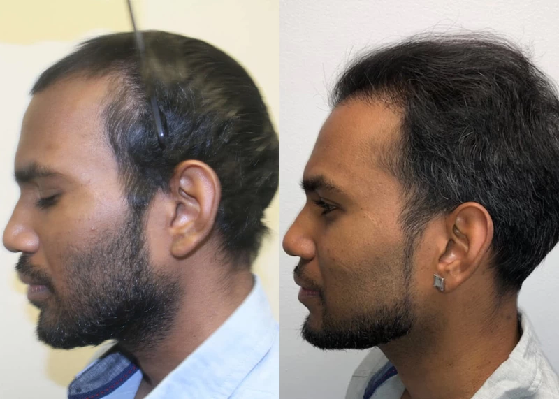 Patient p398 hair transplant before and after left view
