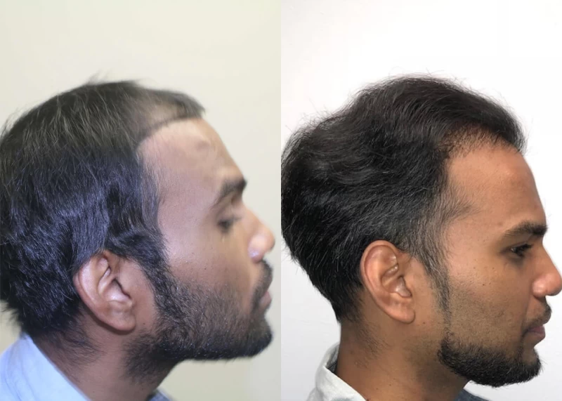 Patient p398 hair transplant before and after right view