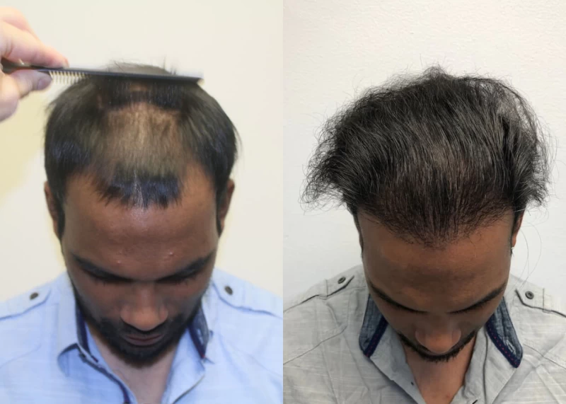 Patient p398 hair transplant before and after tilt view