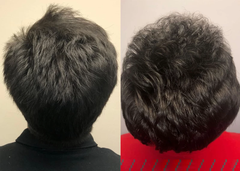 Patient p399 hair transplant before and after crown view