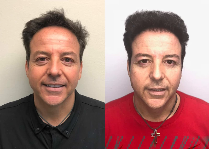 Peter Hair Transplant Before and After