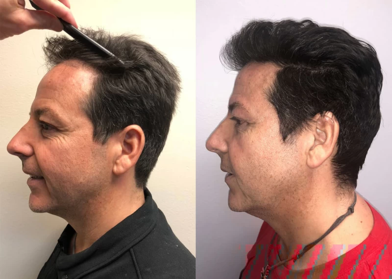 Patient p399 hair transplant before and after left view