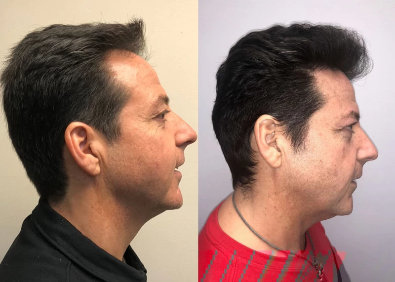 Patient p399 hair transplant before and after right view